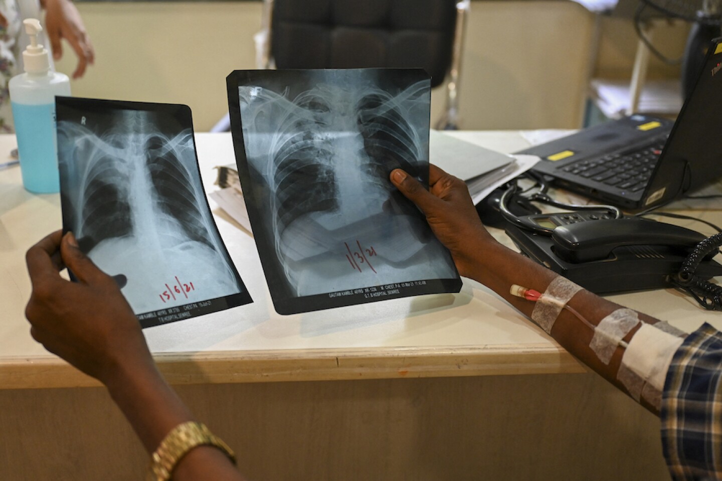 casos de tuberculosis