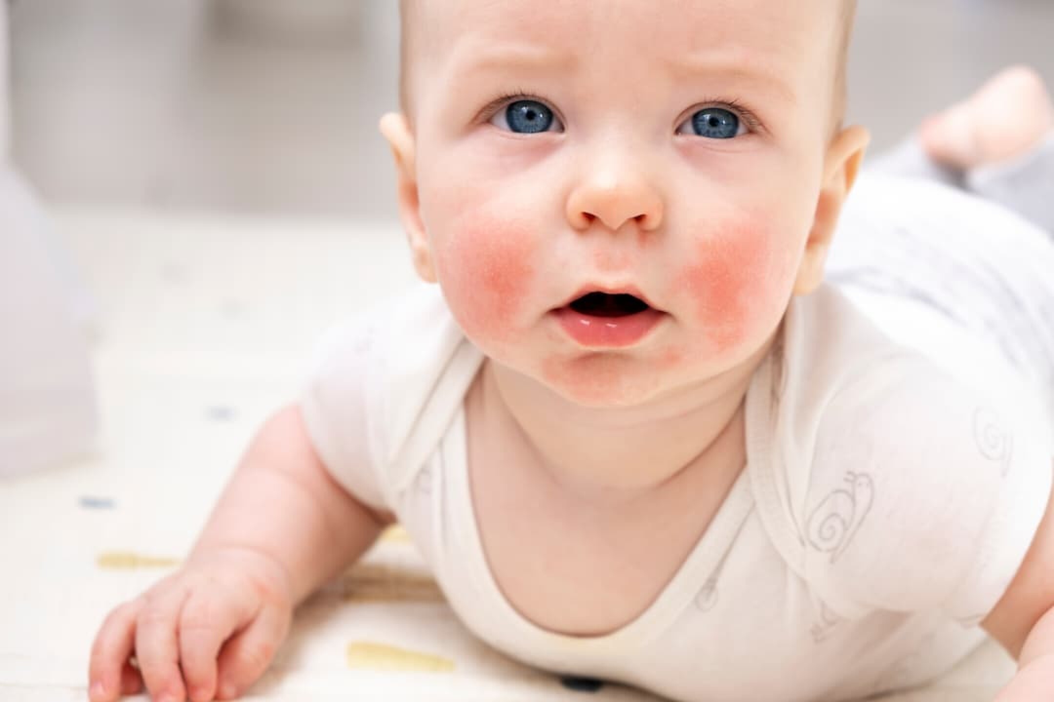 baby-face-with-eczema-on-cheeks-atopic-dermatitis-2023-11-27-05-16-33-utc-1