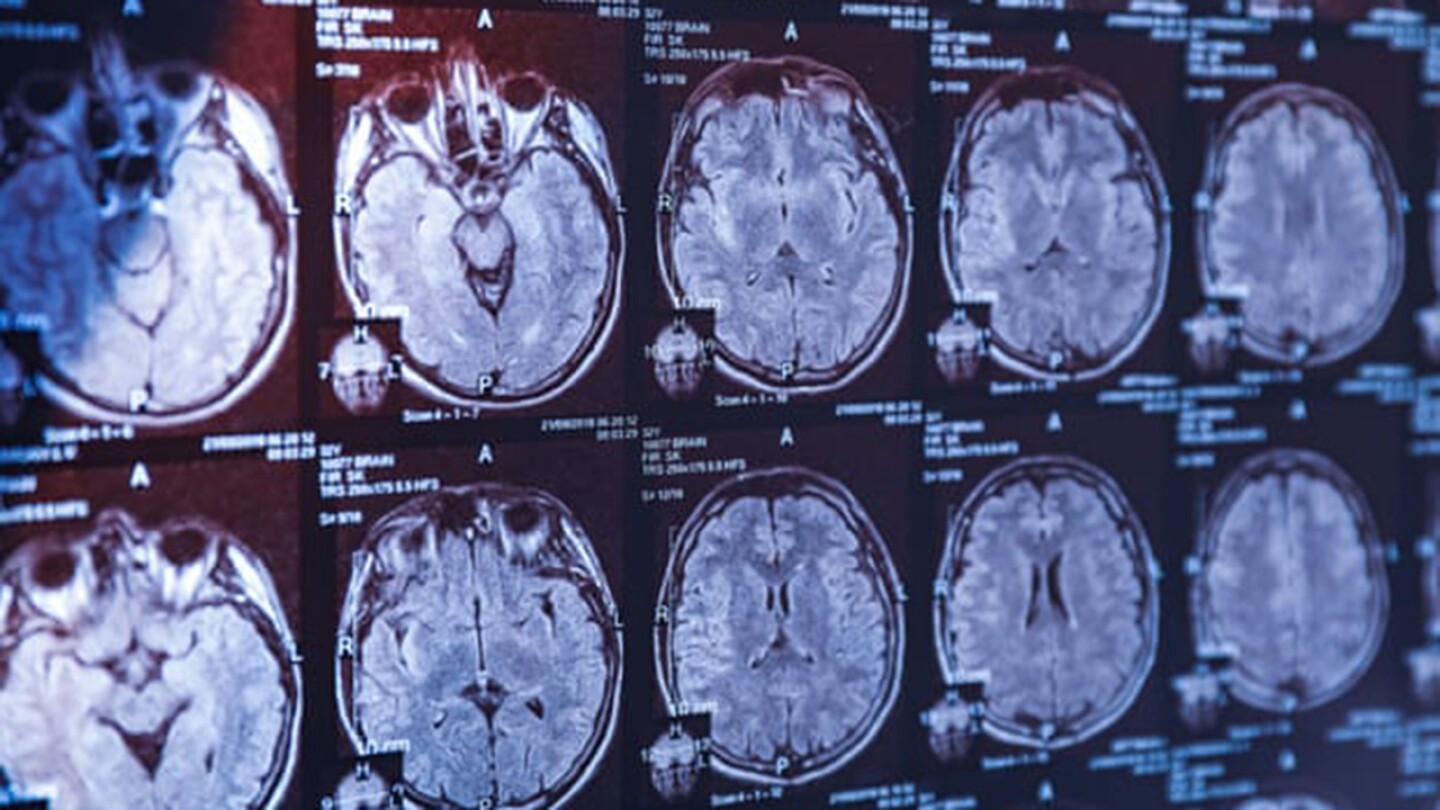 cerebro