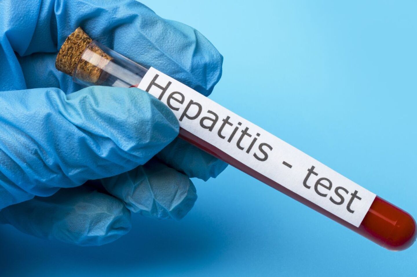 dia-mundial-contra-la-hepatitis-el-virus-silencioso-que-ya-supera-al-vih-en-muertes-con-1-3-millones-al-ano