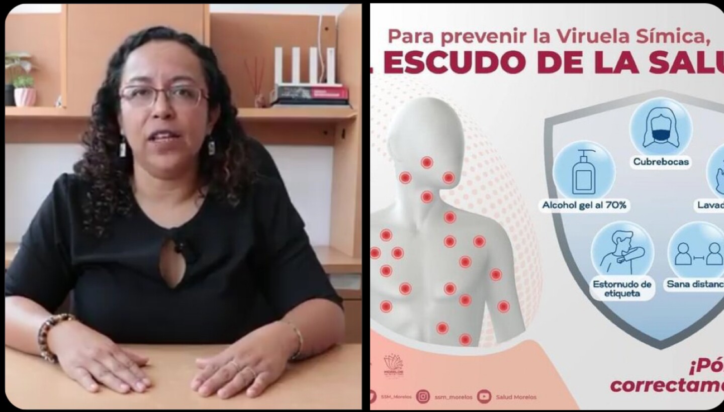 Morelos casos confirmados viruela del mono