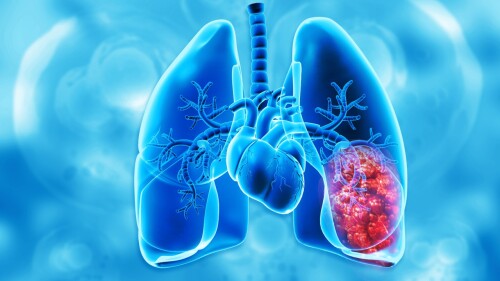 tratamiento-cancer-de-pulmon-alk