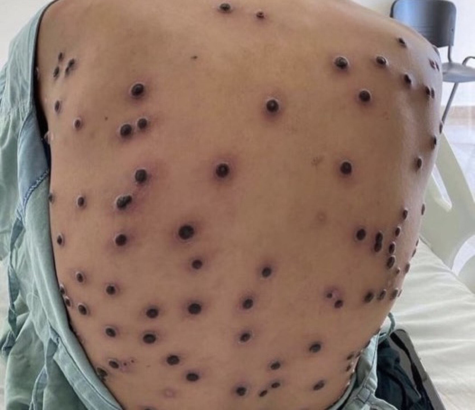 Viruela del mono Mpox