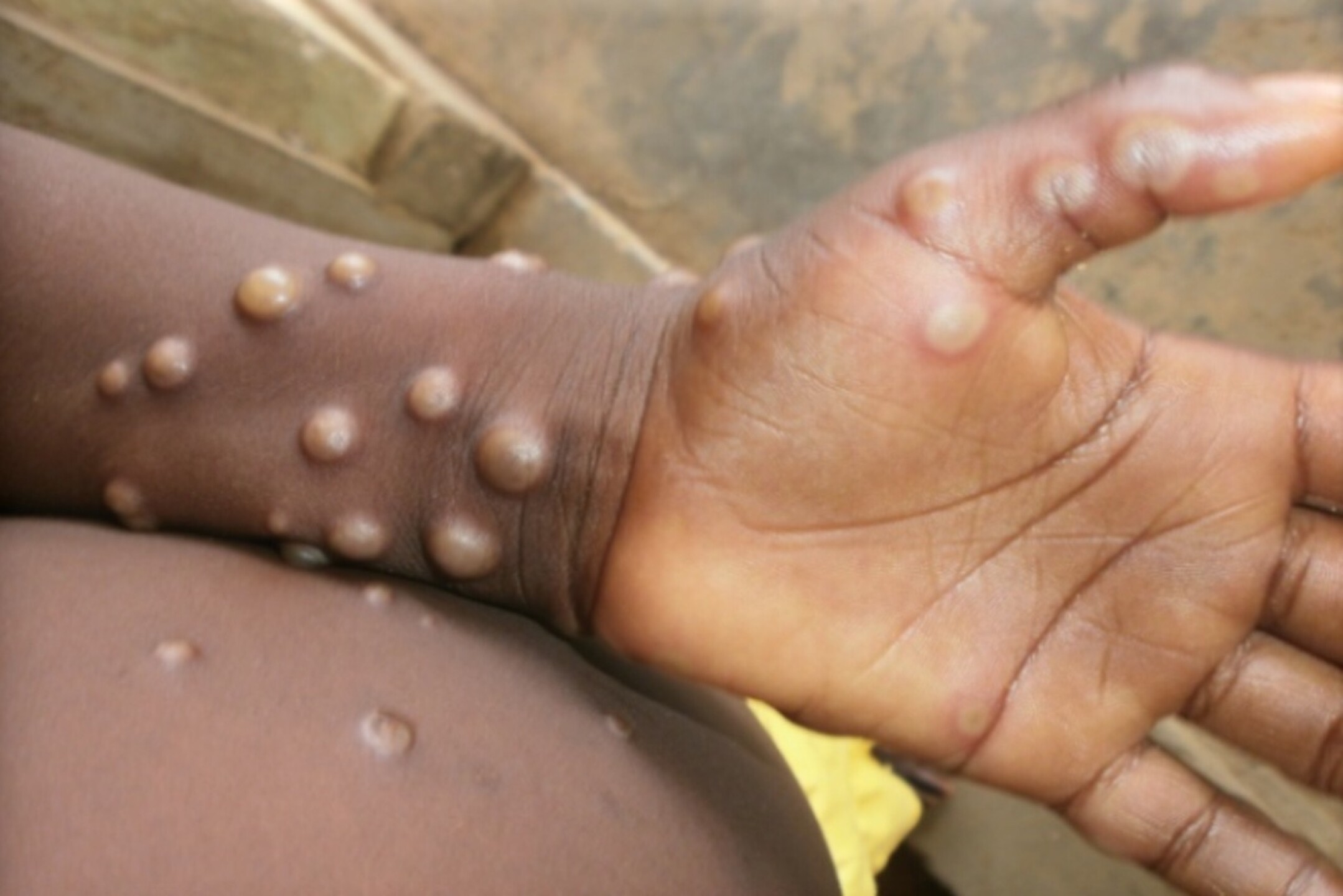 viruela-del-mono-emergencia-internacional-oms