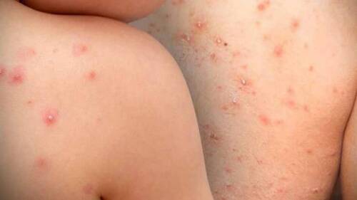 Reportan en EU la epidemia de sarampión más grande del siglo