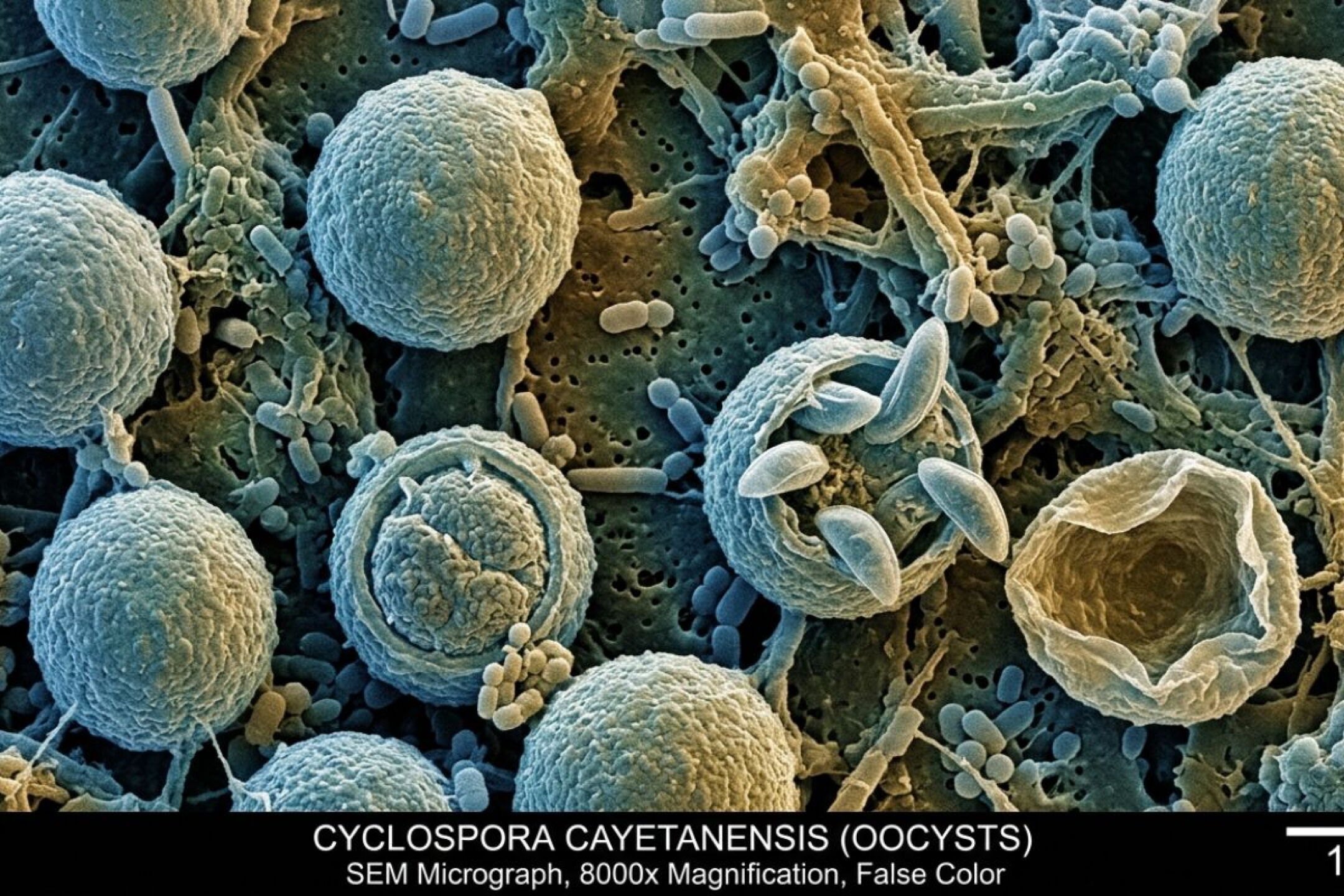 ciclosporiasis parasito sintomas diarrea extremo y tratamiento