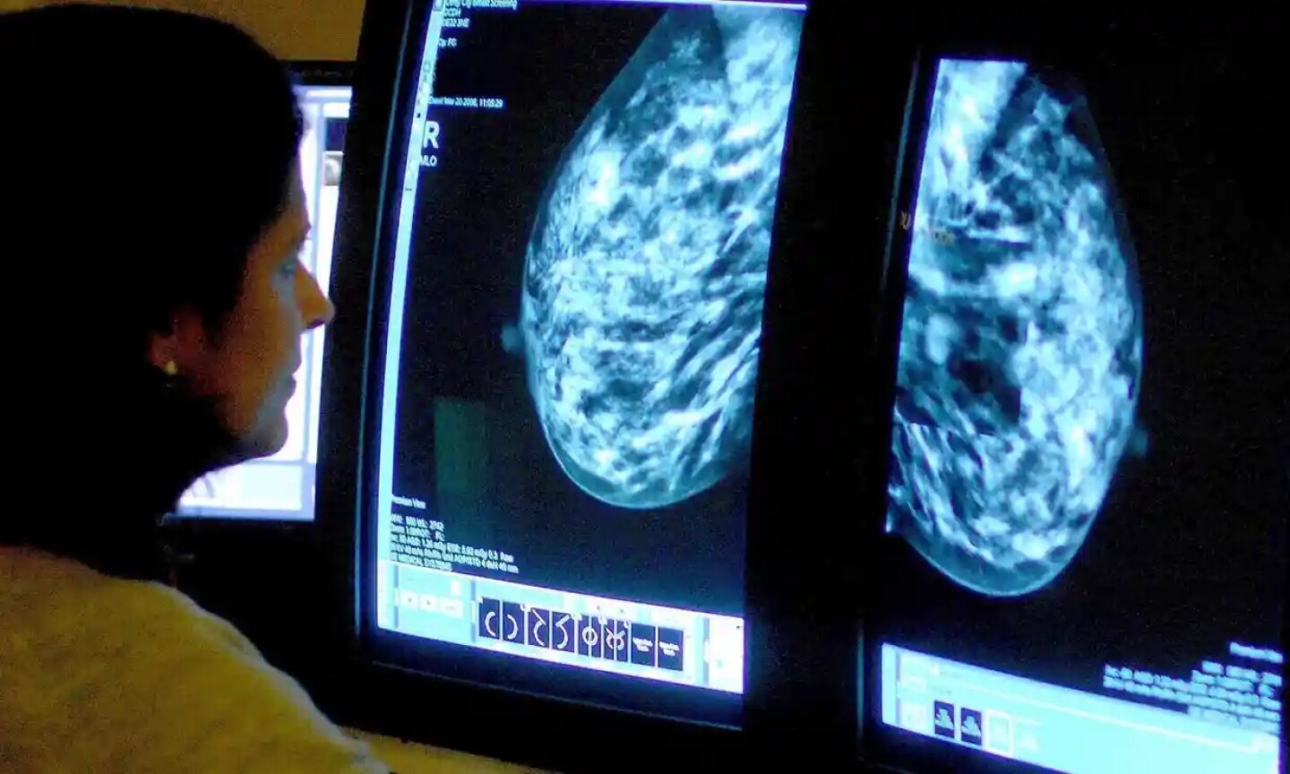 ribociclib_reaparición_cáncer_de_mama