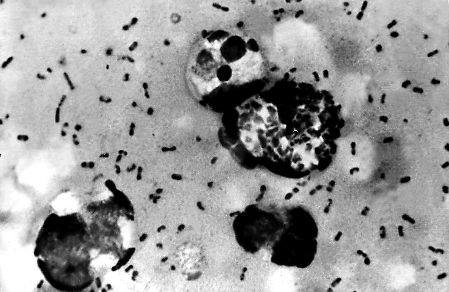 US-BUBONIC PLAGUE 2