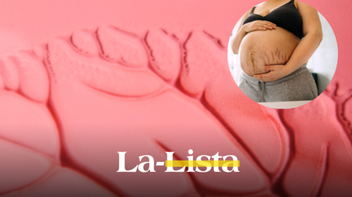 se-pueden-quitar-las-estrias-rojas-con-ejercicio-o-remedios-caseros-causas-cuidados-y-tratamientos-para-eliminarlas.png
