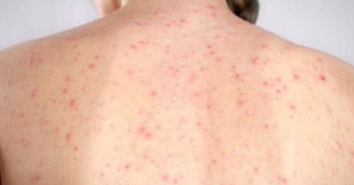 Casos de sarampión se disparan en México en 2026: más contagios ...