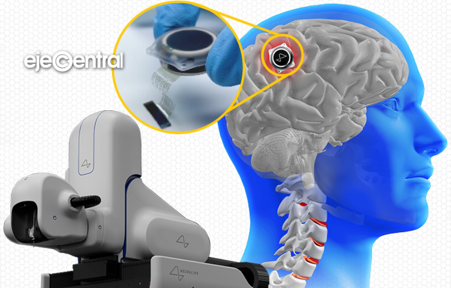 implantes cerebrales