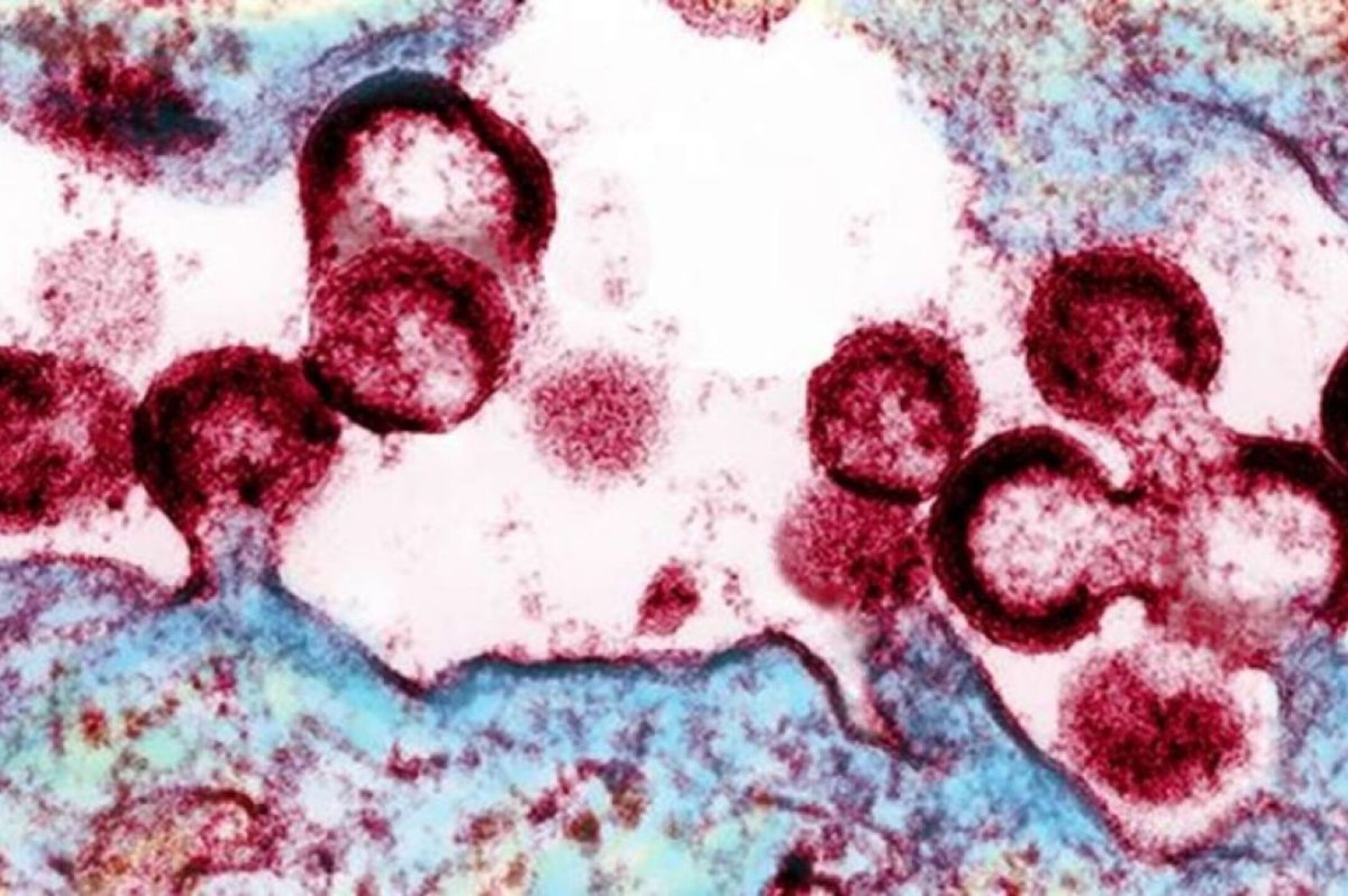 VIH en México 2025: reportan más de 15 mil nuevos contagios; alertan ...