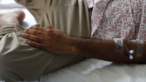 viruela-del-mono-efe (1)