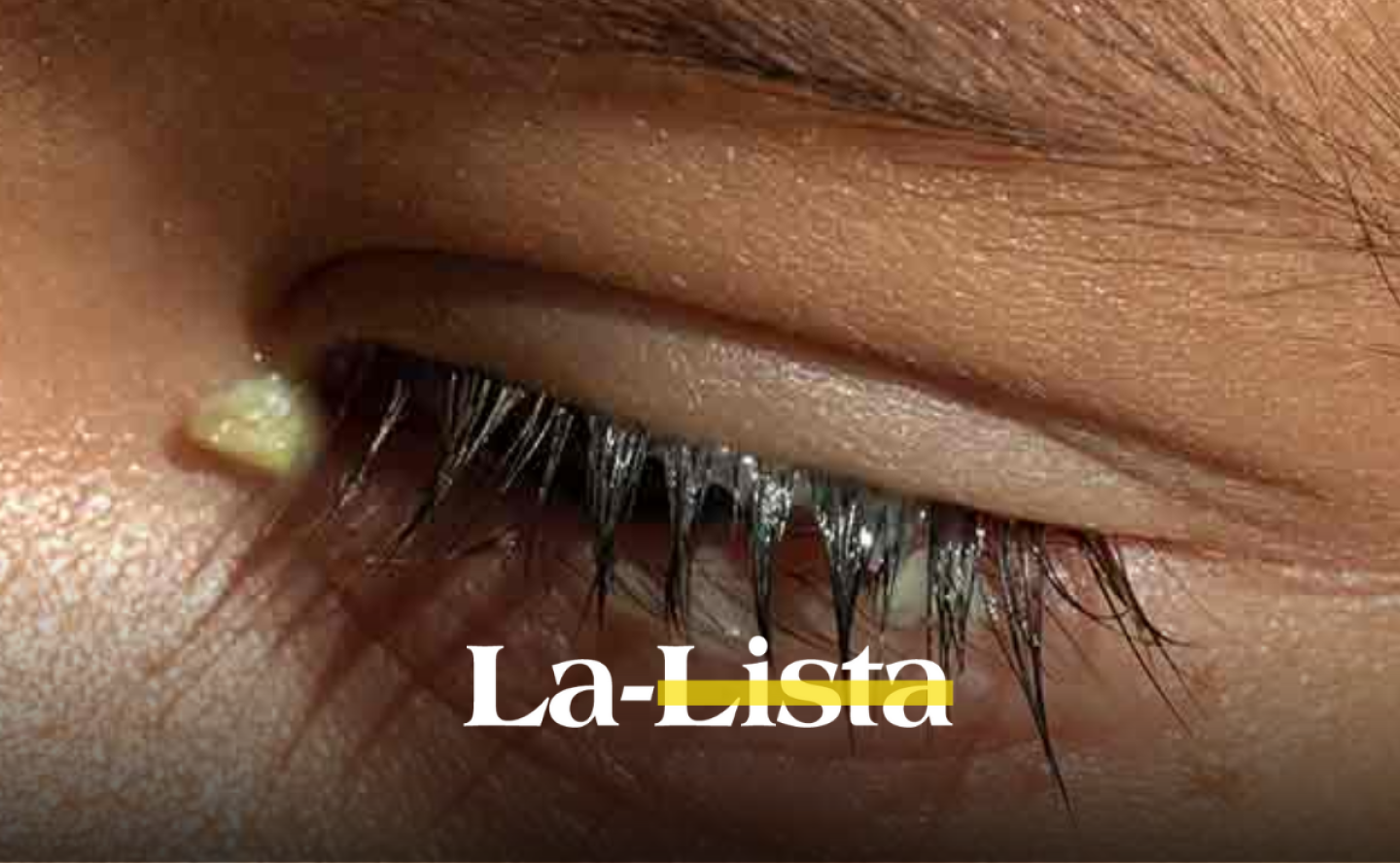 como-se-quitan-las-laganas-en-los-ojos-y-por-que-salen-al-despertar-estas-cinco-enfermedades-las-producen-sintomas.png