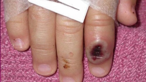 viruela-del-mono-sonora-efe