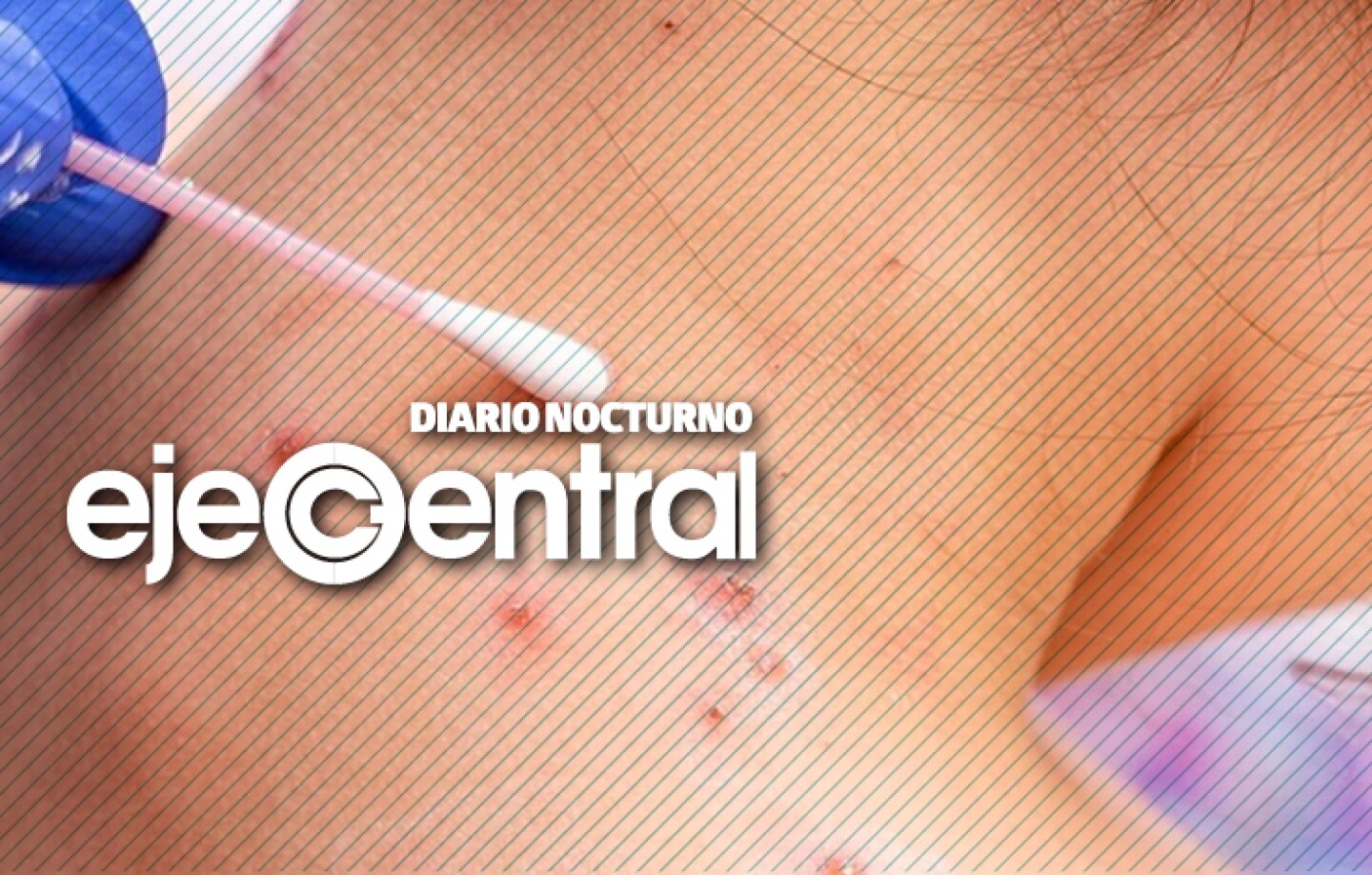 Promo_607_3_ViruelaMono