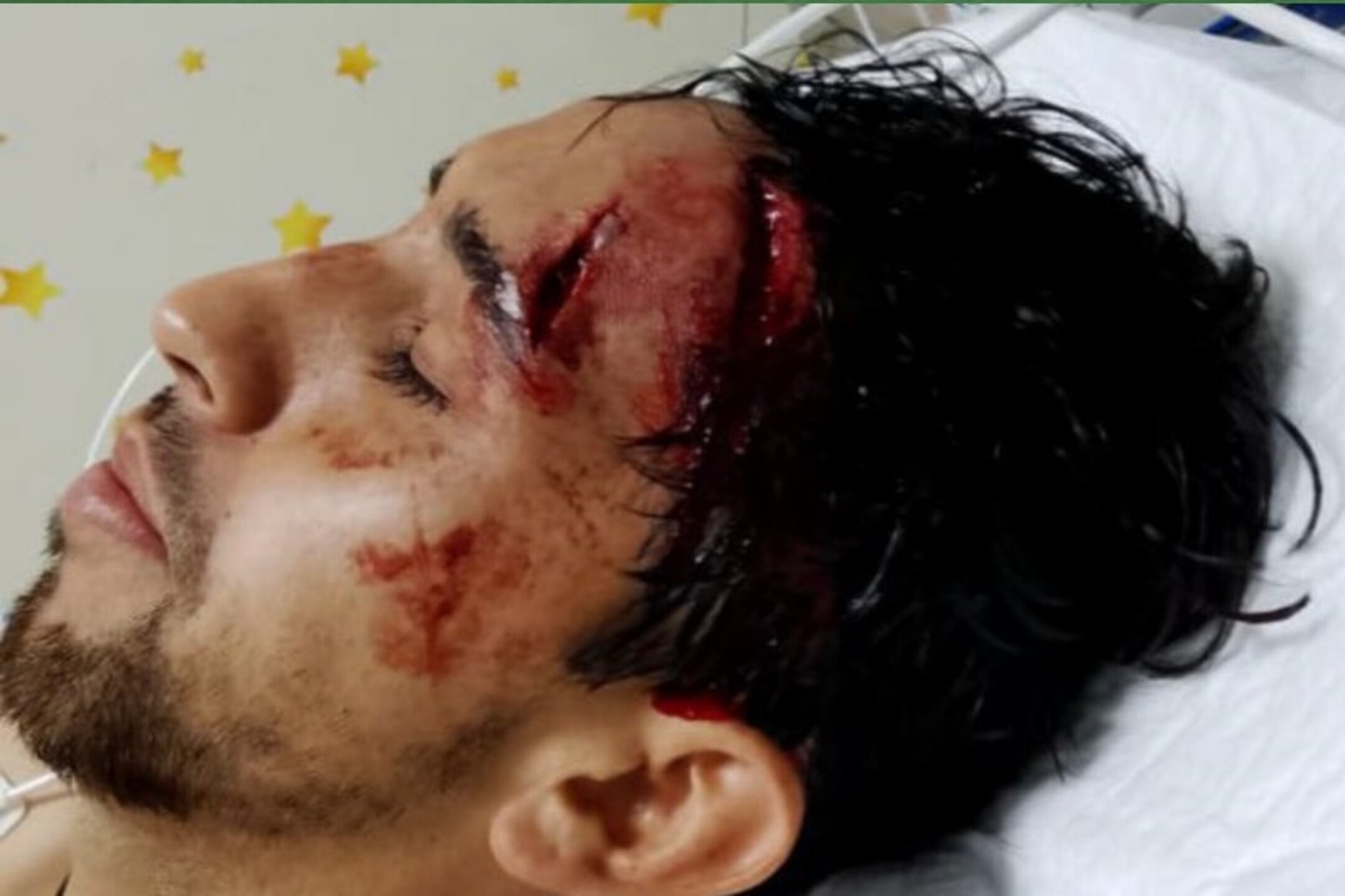 diego-aguilar-herida