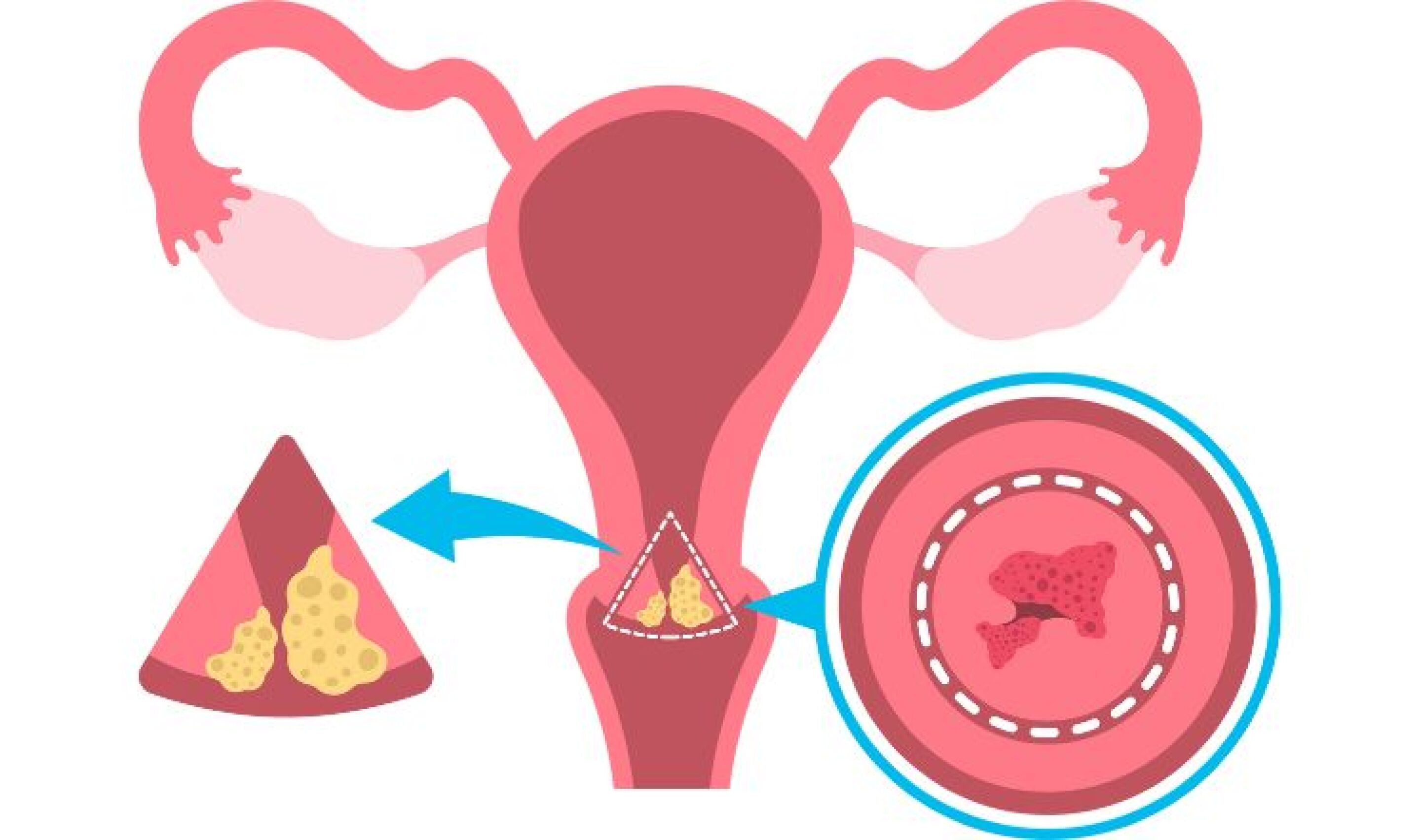 Virus del Papiloma Humano (VPH): Riesgos y consecuencias para la salud ...