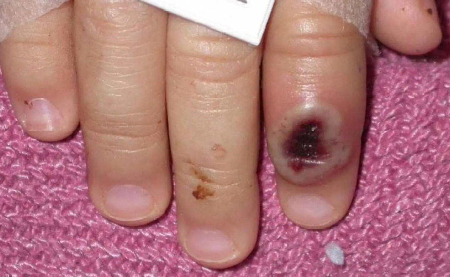 jalisco-viruela-del-mono-efe (1)