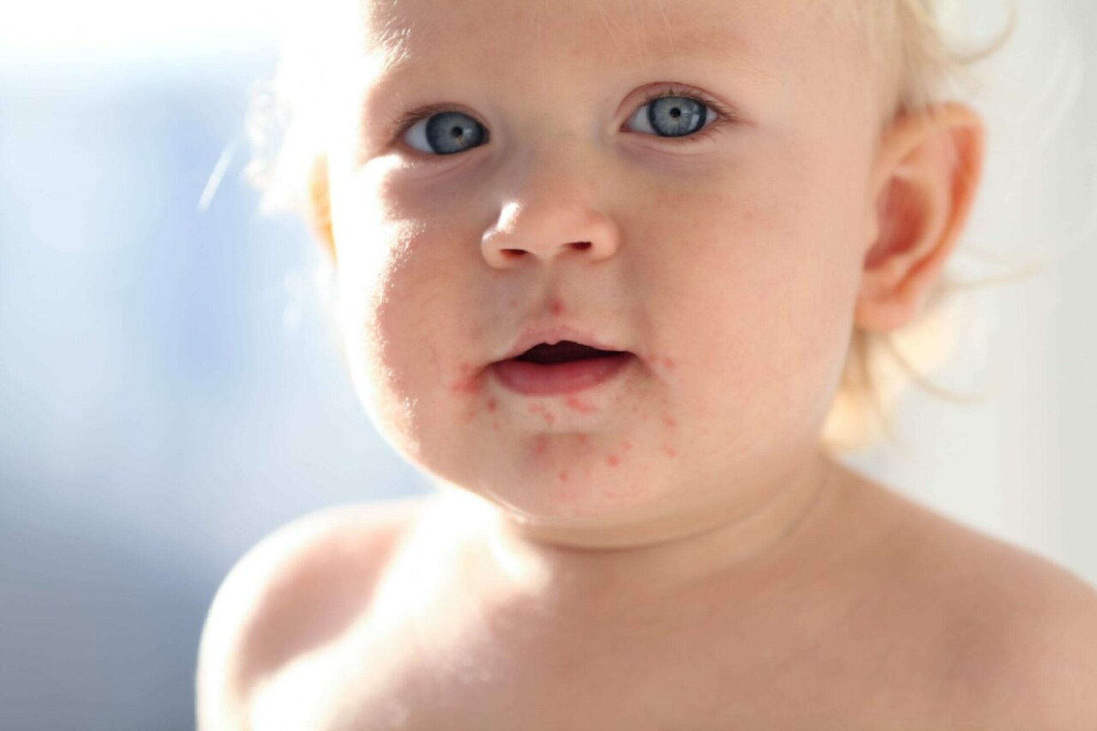 portrait-of-a-baby-with-a-rash-near-the-mouth-ent-2023-03-29-17-33-26-utc-1-1280x853