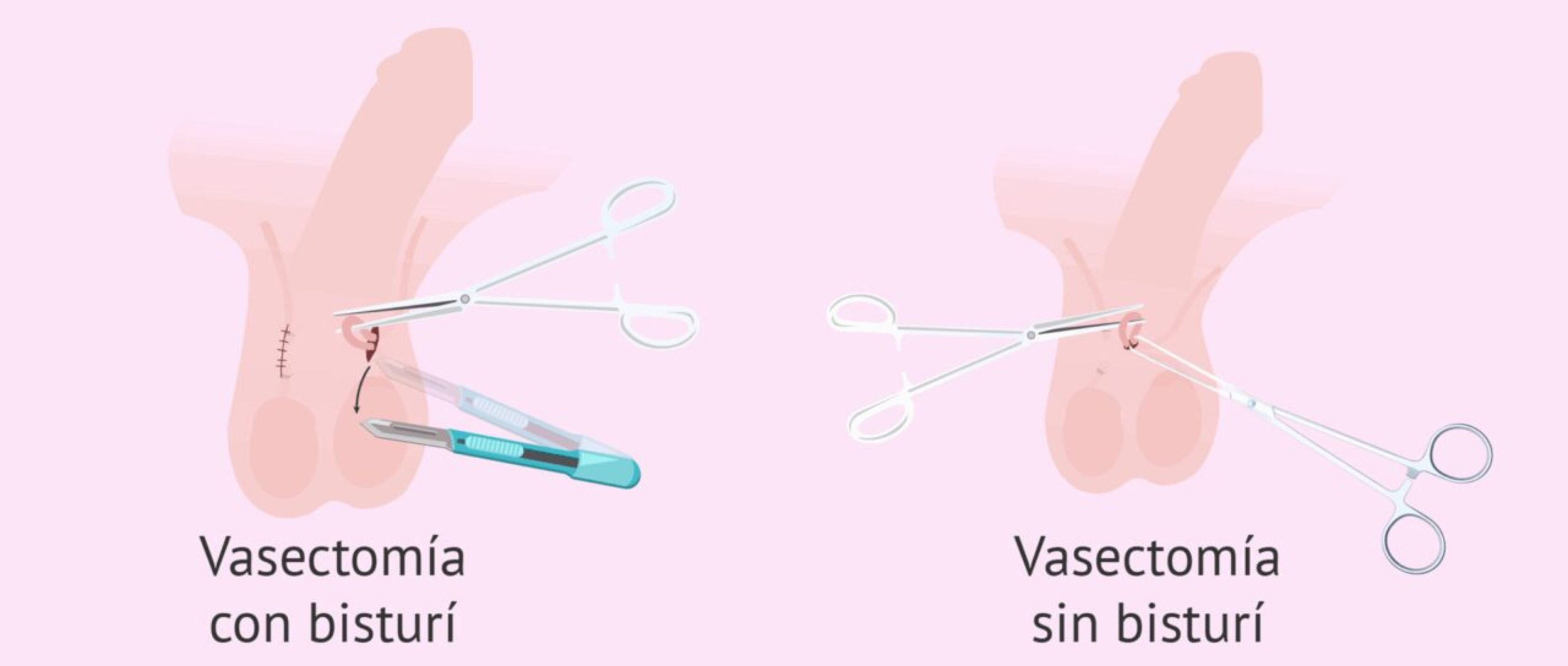Vasectomia-con-y-sin-bisturi-4-1280x544