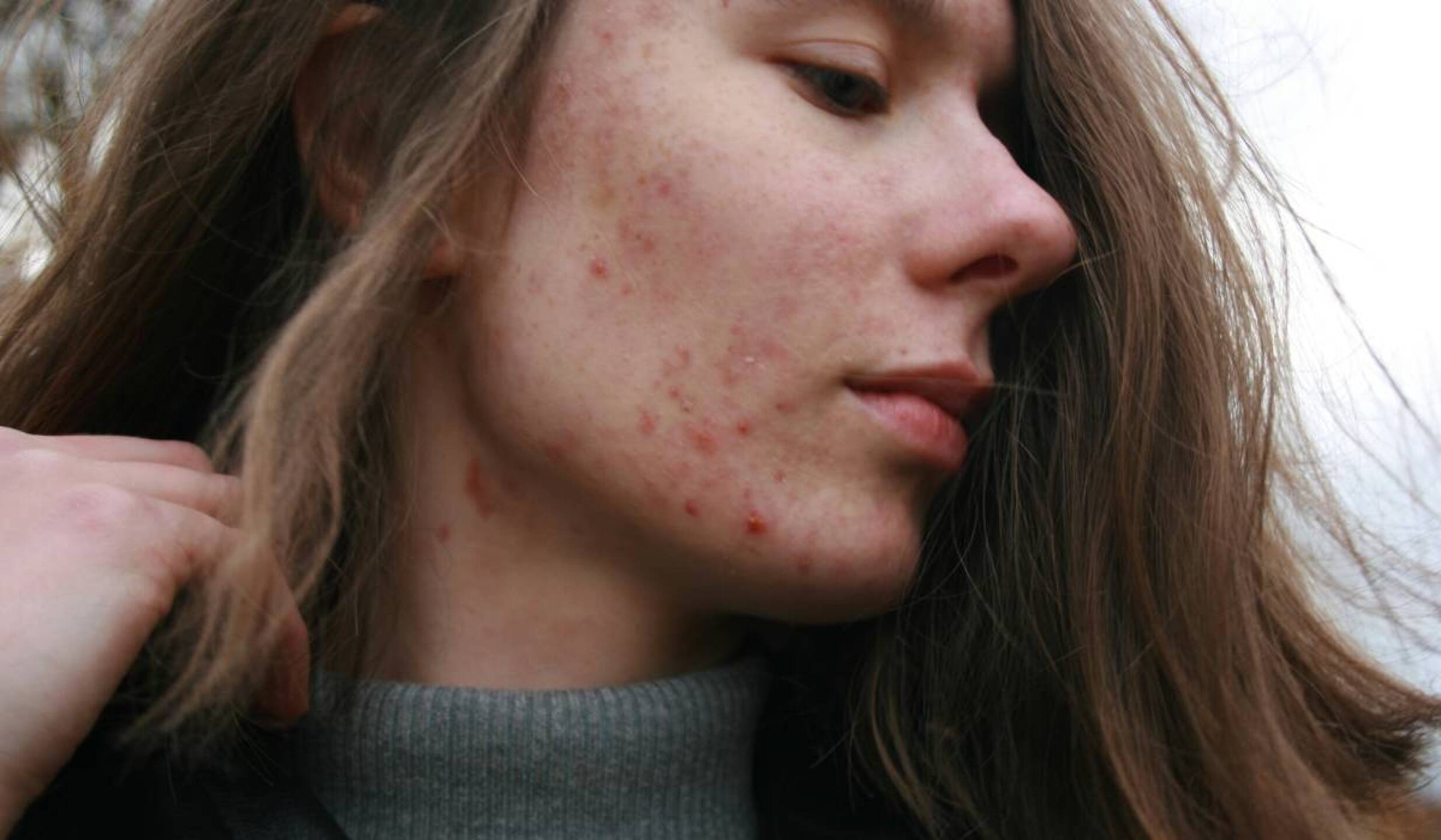 remedios caseros para quitar acne de la cara(2).jpg