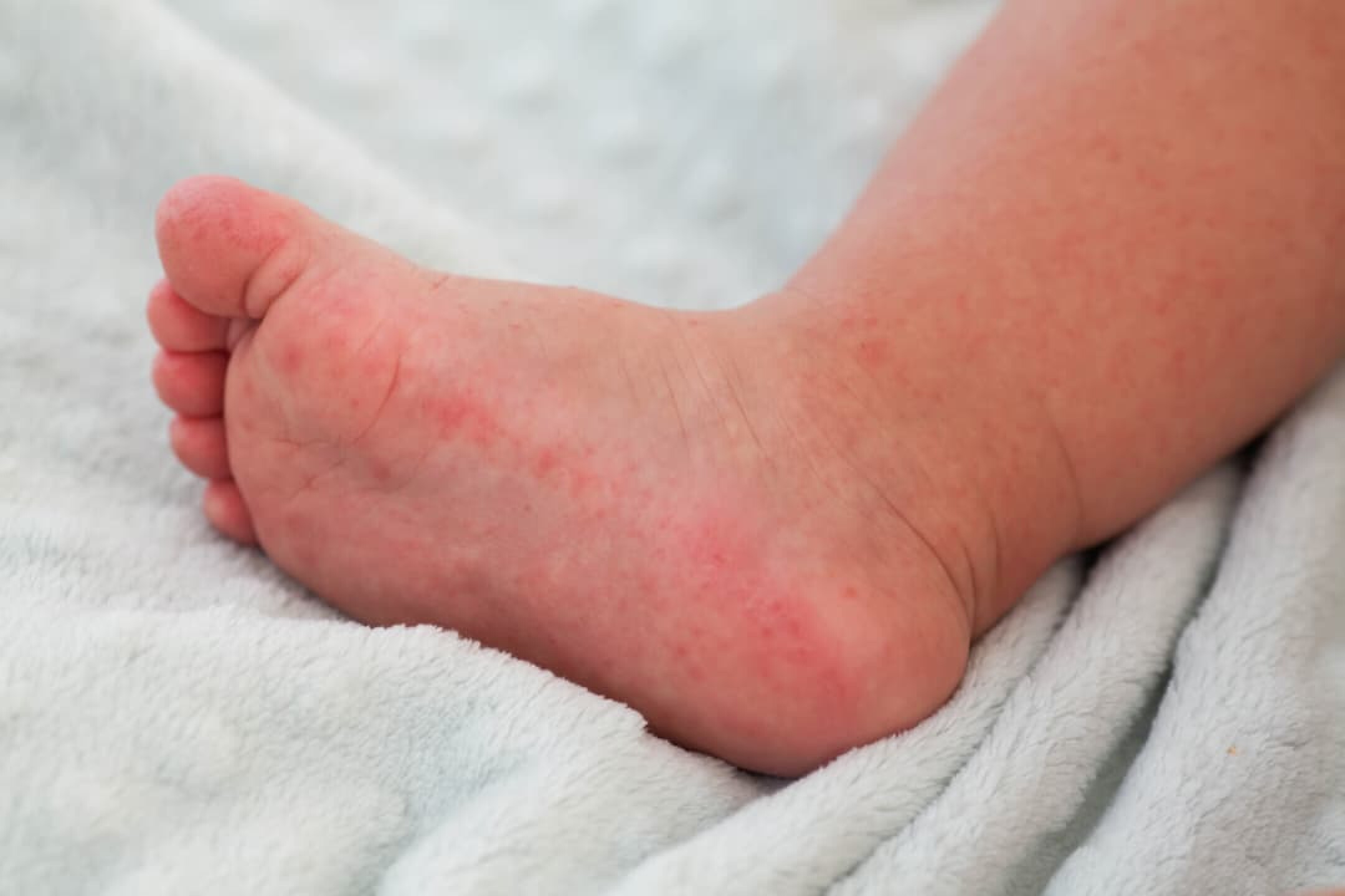 a-small-child-with-a-red-rash-on-the-leg-sits-on-t-2023-11-27-05-00-37-utc-1