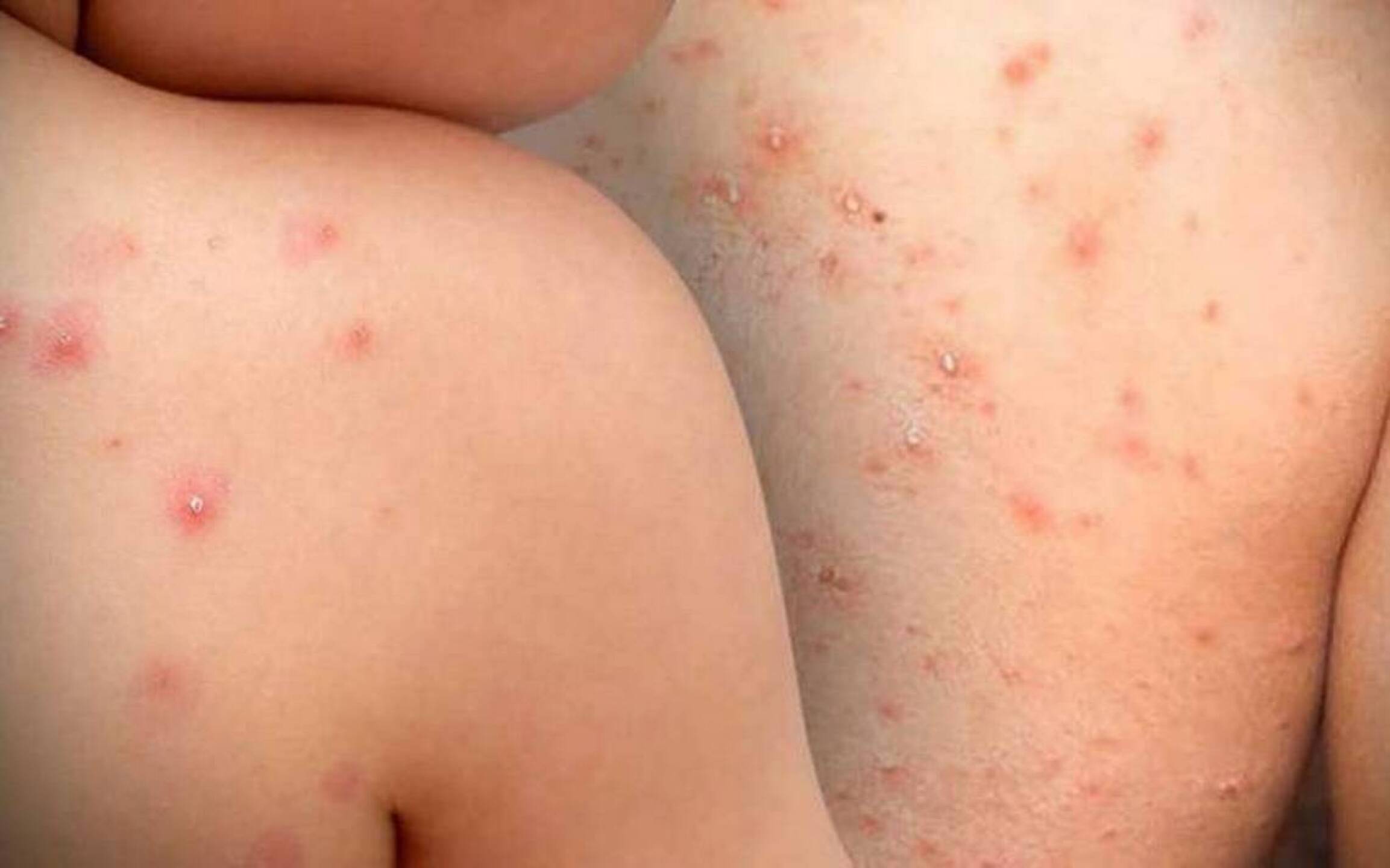 Reportan en EU la epidemia de sarampión más grande del siglo